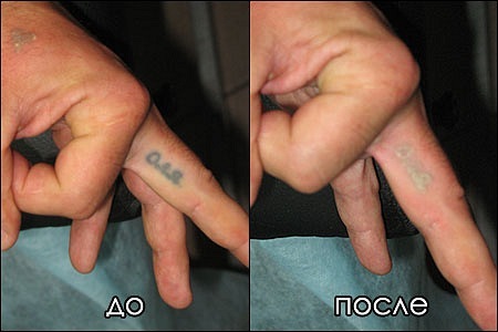 Если место тату опухло Если место тату опухло